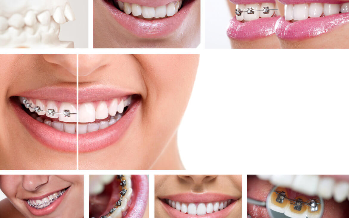 images of fastbraces